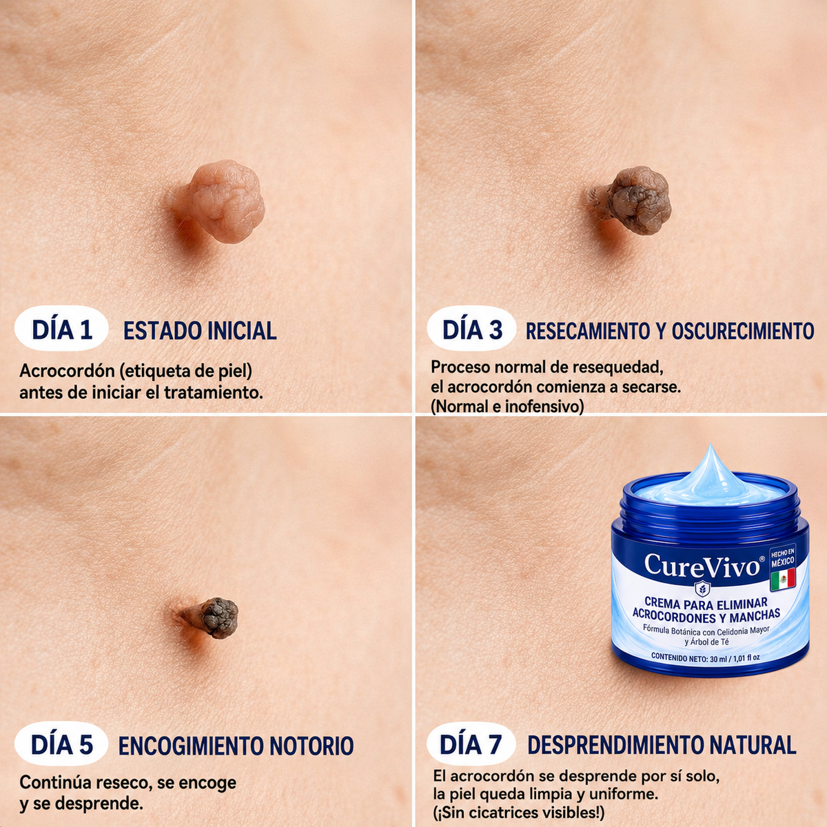 𝐂𝐮𝐫𝐞𝐕𝐢𝐯𝐨® 🛒𝐂𝐫𝐞𝐦𝐚 𝐝𝐞 𝟕 𝐝í𝐚𝐬 𝐩𝐚𝐫𝐚 𝐞𝐥𝐢𝐦𝐢𝐧𝐚𝐫 𝐚𝐜𝐫𝐨𝐜𝐨𝐫𝐝𝐨𝐧𝐞𝐬 𝐲 𝐦𝐚𝐧𝐜𝐡𝐚𝐬 (𝐟ó𝐫𝐦𝐮𝐥𝐚 𝐬𝐢𝐧 𝐝𝐨𝐥𝐨𝐫 – 𝐬𝐢𝐧 𝐜𝐢𝐜𝐚𝐭𝐫𝐢𝐜𝐞𝐬)