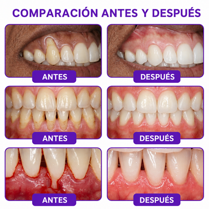 𝐏𝐚𝐬𝐭𝐚 𝐝𝐞 𝐝𝐢𝐞𝐧𝐭𝐞𝐬 𝐇𝐄𝐀𝐓𝐖𝐎𝐋® 🦷𝐕𝐢𝐨𝐂𝐨𝐫𝐞 𝐩𝐚𝐫𝐚 𝐞𝐥 𝐭𝐫𝐚𝐭𝐚𝐦𝐢𝐞𝐧𝐭𝐨 𝐝𝐞 𝐥𝐚 𝐢𝐧𝐟𝐥𝐚𝐦𝐚𝐜𝐢ó𝐧 𝐝𝐞 𝐥𝐚𝐬 𝐞𝐧𝐜í𝐚𝐬 𝐲 𝐥𝐚 𝐩𝐞𝐫𝐢𝐨𝐝𝐨𝐧𝐭𝐢𝐭𝐢𝐬