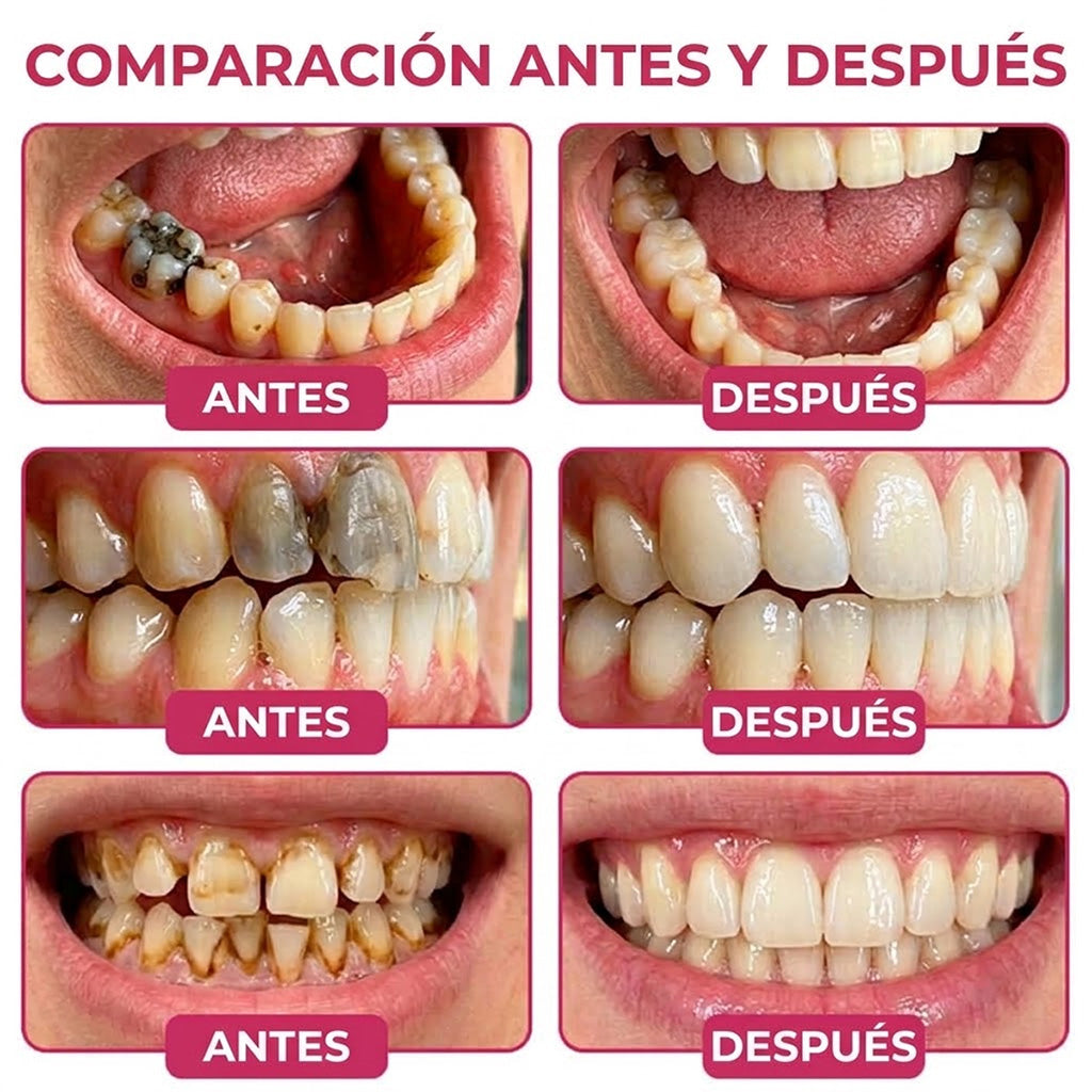 Trilumia® DenPerm🦷🥫🥫 Gel reparador de caries y relleno de esmalte natural