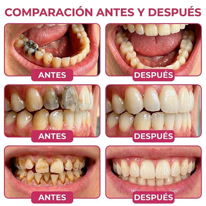Trilumia® DenPerm🦷🥫🥫 Gel reparador de caries y relleno de esmalte natural