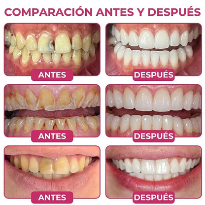 Trilumia® DenPerm🦷🥫🥫 Gel reparador de caries y relleno de esmalte natural