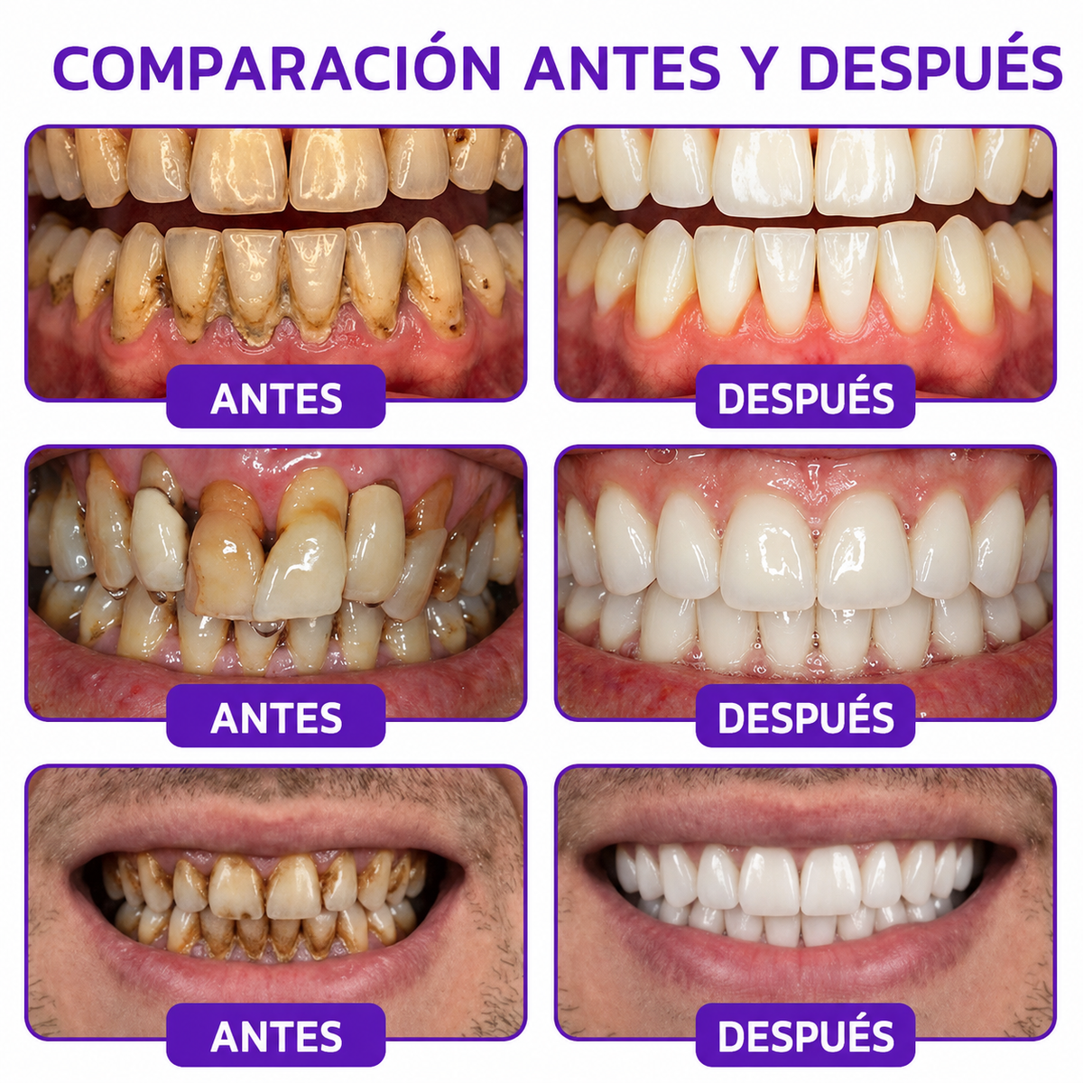 𝐏𝐚𝐬𝐭𝐚 𝐝𝐞 𝐝𝐢𝐞𝐧𝐭𝐞𝐬 𝐇𝐄𝐀𝐓𝐖𝐎𝐋® 🦷𝐕𝐢𝐨𝐂𝐨𝐫𝐞 𝐩𝐚𝐫𝐚 𝐞𝐥 𝐭𝐫𝐚𝐭𝐚𝐦𝐢𝐞𝐧𝐭𝐨 𝐝𝐞 𝐥𝐚 𝐢𝐧𝐟𝐥𝐚𝐦𝐚𝐜𝐢ó𝐧 𝐝𝐞 𝐥𝐚𝐬 𝐞𝐧𝐜í𝐚𝐬 𝐲 𝐥𝐚 𝐩𝐞𝐫𝐢𝐨𝐝𝐨𝐧𝐭𝐢𝐭𝐢𝐬
