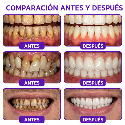 𝐏𝐚𝐬𝐭𝐚 𝐝𝐞 𝐝𝐢𝐞𝐧𝐭𝐞𝐬 𝐇𝐄𝐀𝐓𝐖𝐎𝐋® 🦷𝐕𝐢𝐨𝐂𝐨𝐫𝐞 𝐩𝐚𝐫𝐚 𝐞𝐥 𝐭𝐫𝐚𝐭𝐚𝐦𝐢𝐞𝐧𝐭𝐨 𝐝𝐞 𝐥𝐚 𝐢𝐧𝐟𝐥𝐚𝐦𝐚𝐜𝐢ó𝐧 𝐝𝐞 𝐥𝐚𝐬 𝐞𝐧𝐜í𝐚𝐬 𝐲 𝐥𝐚 𝐩𝐞𝐫𝐢𝐨𝐝𝐨𝐧𝐭𝐢𝐭𝐢𝐬
